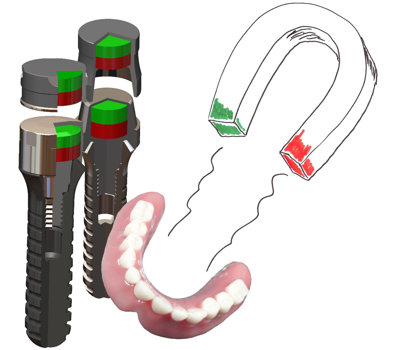 Magnetic dentures – Steco