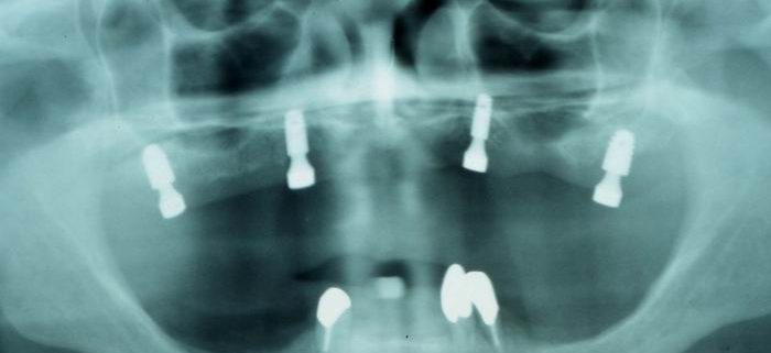 Röntgenbild von Magneten im Oberkiefer