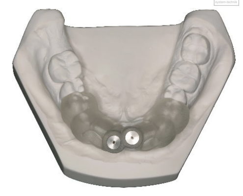 Bohrschablone für Endodontie